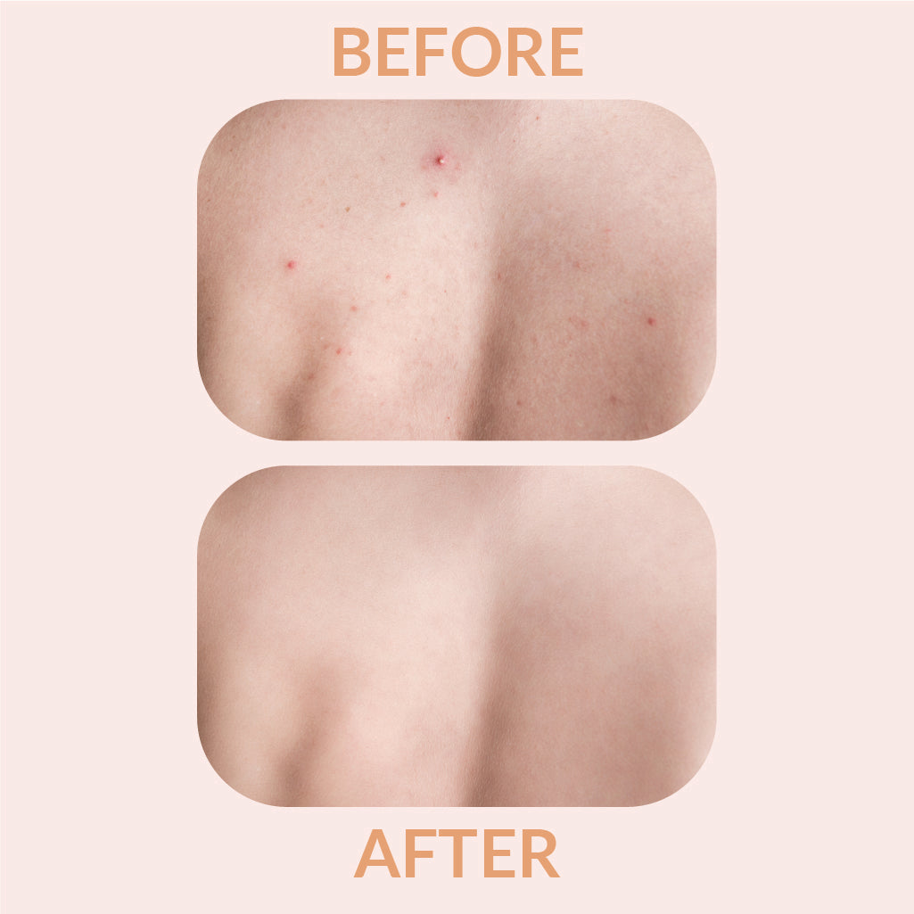 Spot Clearing Patch XL - 10 Patches